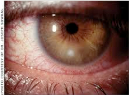 Bacterial Keratitis